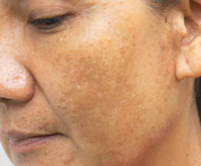 Melasma