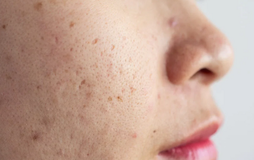Post-Acne