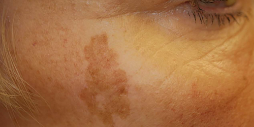 Sun Spots